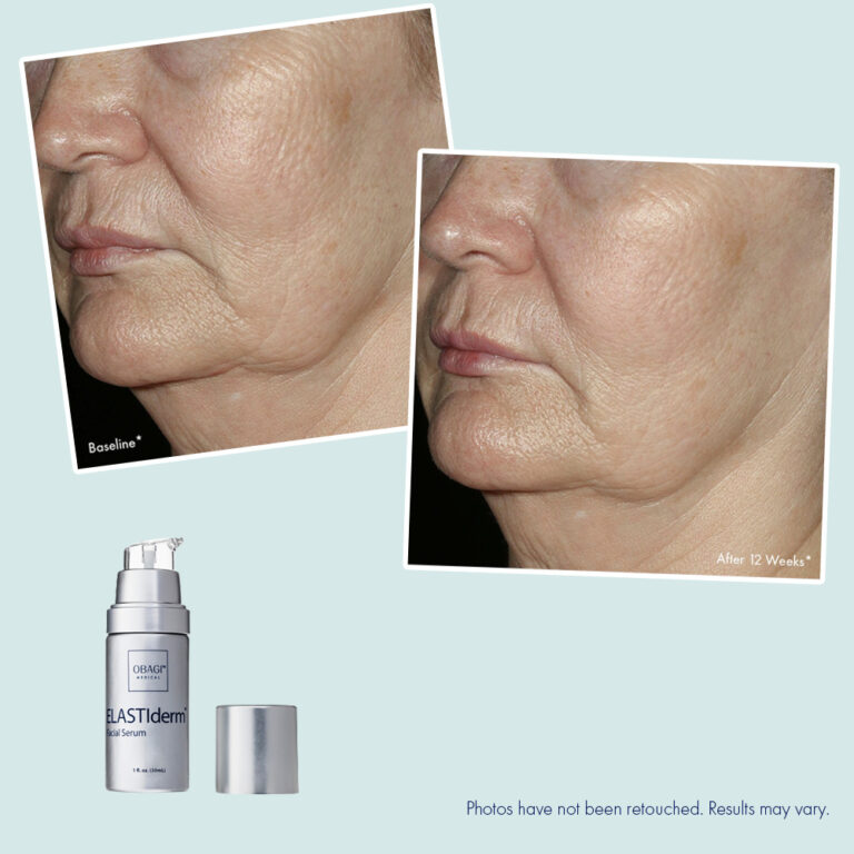 Obagi ELASTIderm® Facial Serum – Before & After
